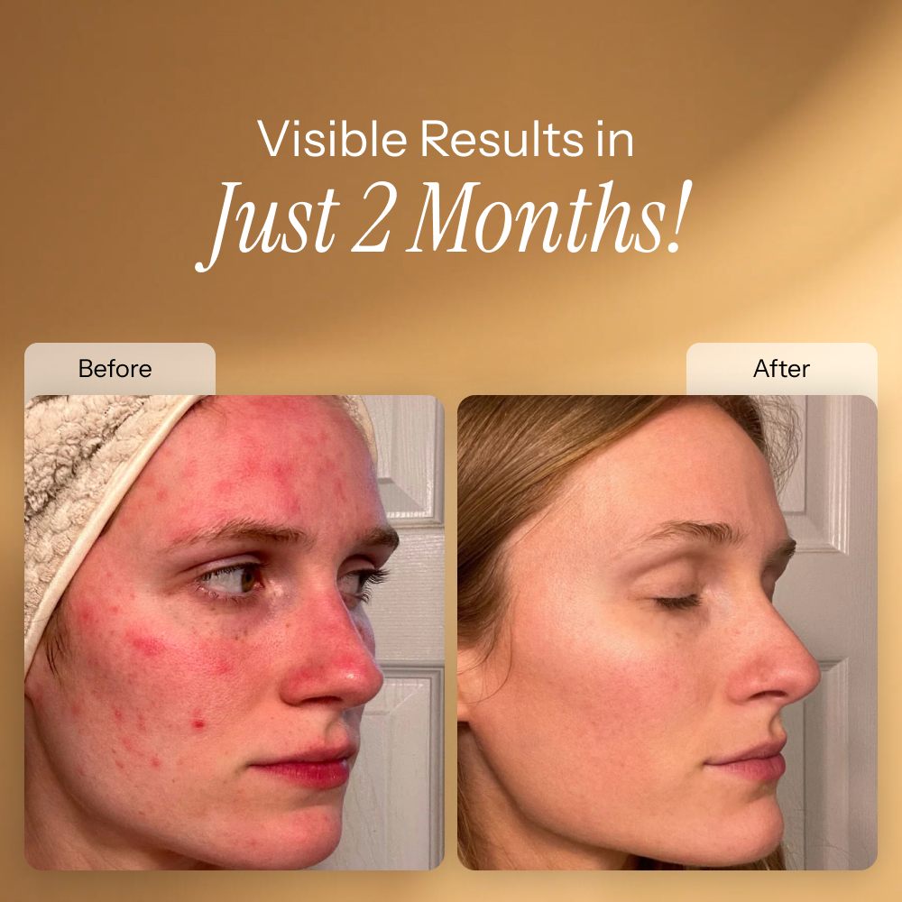 Before and after photos showing calmer, more even skin after two months of use